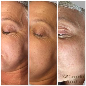 Cosmetic acupuncture